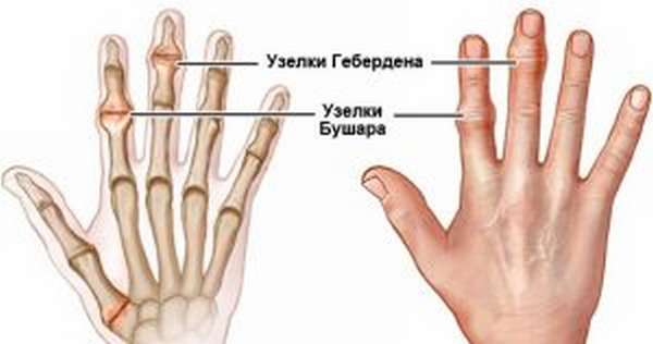 Остеоартроз на фалангах пальцев